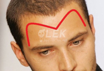 C&aacute;ch khắc phục T&oacute;c thưa v&agrave; h&oacute;i chữ M v&agrave; kiểu t&oacute;c che khuyết điểm