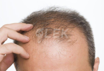 Khoa Học Về Nang T&oacute;c - Tại Sao T&oacute;c Nam Yếu Sau Tuổi 30 V&agrave; Giải Ph&aacute;p Từ C&aacute;c Barber